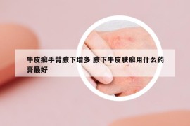 牛皮癬手臂腋下增多 腋下牛皮膚癬用什么藥膏最好