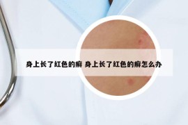 身上長(zhǎng)了紅色的癬 身上長(zhǎng)了紅色的癬怎么辦
