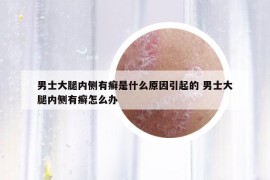 男士大腿內(nèi)側(cè)有癬是什么原因引起的 男士大腿內(nèi)側(cè)有癬怎么辦