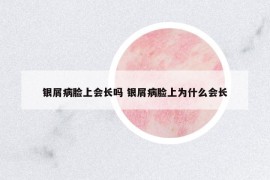 銀屑病臉上會(huì)長(zhǎng)嗎 銀屑病臉上為什么會(huì)長(zhǎng)