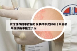 震驚世界的中古秘方皮膚癢牛皮鮮頑廯銀屑病 牛皮膚癬中醫(yī)怎么治