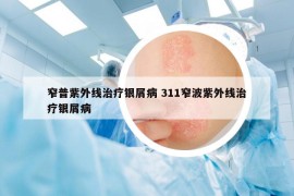 窄普紫外線治療銀屑病 311窄波紫外線治療銀屑病