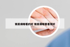 銀屑病哪看的好 銀屑病哪里看得好