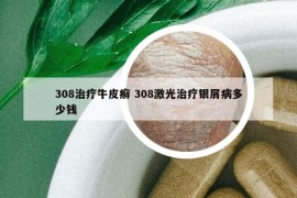 308治療牛皮癬 308激光治療銀屑病多少錢