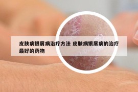 皮膚病銀屑病治療方法 皮膚病銀屑病的治療最好的藥物