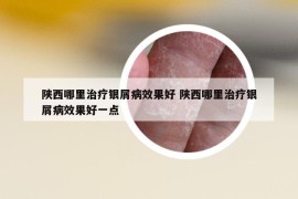 陜西哪里治療銀屑病效果好 陜西哪里治療銀屑病效果好一點(diǎn)