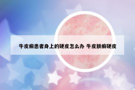 牛皮癬患者身上的硬皮怎么辦 牛皮膚癬硬皮