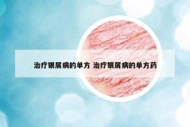 治療銀屑病的單方 治療銀屑病的單方藥