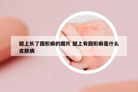 腿上長了圓形癬的圖片 腿上有圓形癬是什么皮膚病