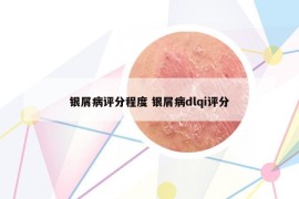 銀屑病評(píng)分程度 銀屑病dlqi評(píng)分