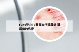 ruxolitinib乳膏治療銀屑病 銀屑病的乳膏