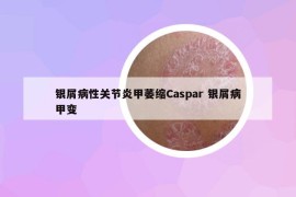 銀屑病性關(guān)節(jié)炎甲萎縮Caspar 銀屑病甲變
