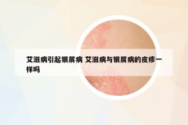 艾滋病引起銀屑病 艾滋病與銀屑病的皮疹一樣嗎