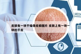 皮膚有一塊干燥像皮癬圖片 皮膚上有一塊一塊的干皮