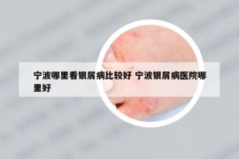 寧波哪里看銀屑病比較好 寧波銀屑病醫(yī)院哪里好