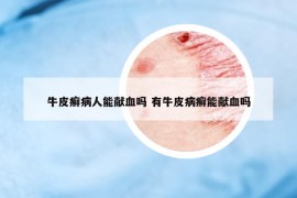 牛皮癬病人能獻(xiàn)血嗎 有牛皮病癬能獻(xiàn)血嗎