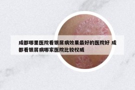 成都哪里醫(yī)院看銀屑病效果最好的醫(yī)院好 成都看銀屑病哪家醫(yī)院比較權(quán)威