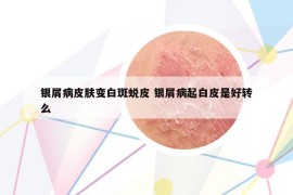 銀屑病皮膚變白斑蛻皮 銀屑病起白皮是好轉(zhuǎn)么