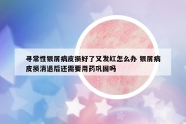 尋常性銀屑病皮損好了又發(fā)紅怎么辦 銀屑病皮損消退后還需要用藥鞏固嗎