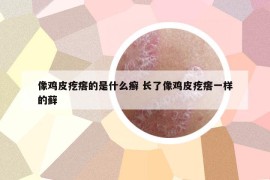 像雞皮疙瘩的是什么癬 長了像雞皮疙瘩一樣的蘚