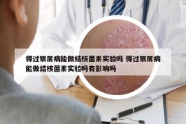 得過銀屑病能做結(jié)核菌素實(shí)驗(yàn)嗎 得過銀屑病能做結(jié)核菌素實(shí)驗(yàn)嗎有影響嗎