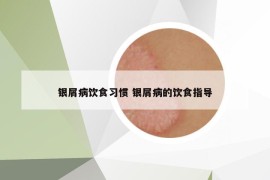 銀屑病飲食習(xí)慣 銀屑病的飲食指導(dǎo)