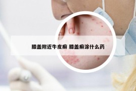 膝蓋附近牛皮癬 膝蓋癬涂什么藥