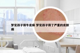 夢見孩子得牛皮癬 夢見孩子得了嚴重的皮膚病
