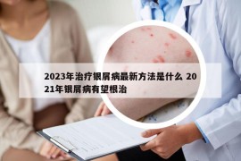 2023年治療銀屑病最新方法是什么 2021年銀屑病有望根治