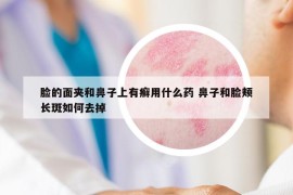 臉的面夾和鼻子上有癬用什么藥 鼻子和臉頰長(zhǎng)斑如何去掉