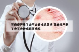 蕁麻疹嚴(yán)重了會(huì)不會(huì)轉(zhuǎn)成銀屑病 蕁麻疹嚴(yán)重了會(huì)不會(huì)轉(zhuǎn)成銀屑病呢