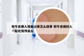 和牛皮癬人接觸過癢怎么回事 和牛皮癬的人一起吃飯傳染么