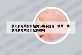 掌跖膿皰病會(huì)引起關(guān)節(jié)疼小腿青一塊紫一塊 掌跖膿皰病能引起骨病嗎