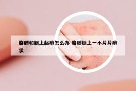 胳膊和腿上起癬怎么辦 胳膊腿上一小片片癬狀