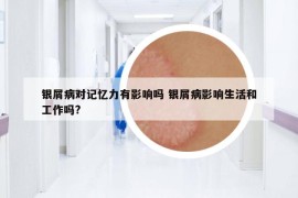 銀屑病對記憶力有影響嗎 銀屑病影響生活和工作嗎?