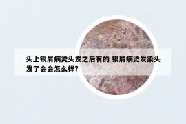 頭上銀屑病燙頭發(fā)之后有的 銀屑病燙發(fā)染頭發(fā)了會(huì)會(huì)怎么樣?