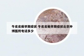 牛皮皮癬早期癥狀 牛皮皮癬早期癥狀北京仲博醫(yī)院電話多少