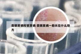 類銀屑病和銀屑病 類銀屑病一般長在什么地方