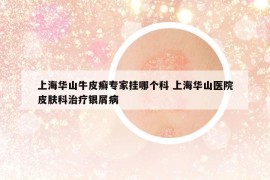 上海華山牛皮癬專家掛哪個(gè)科 上海華山醫(yī)院皮膚科治療銀屑病