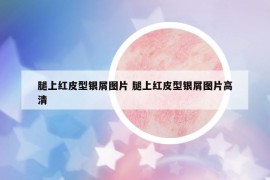 腿上紅皮型銀屑圖片 腿上紅皮型銀屑圖片高清