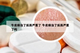 牛皮癬治了反而嚴重了 牛皮癬治了反而嚴重了嗎
