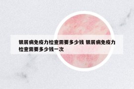銀屑病免疫力檢查需要多少錢 銀屑病免疫力檢查需要多少錢一次