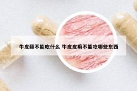 牛皮蘚不能吃什么 牛皮皮癬不能吃哪些東西