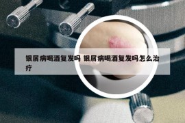 銀屑病喝酒復(fù)發(fā)嗎 銀屑病喝酒復(fù)發(fā)嗎怎么治療