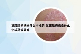 掌跖膿皰病吃什么中成藥 掌跖膿皰病吃什么中成藥效果好