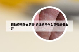 銅錢癬用什么藥膏 銅錢癬用什么藥膏能根治好