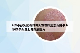6歲小孩頭皮有白斑頭發(fā)也白是怎么回事 6歲孩子頭皮上有白屑圖片