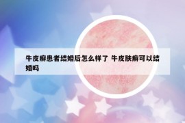 牛皮癬患者結婚后怎么樣了 牛皮膚癬可以結婚嗎