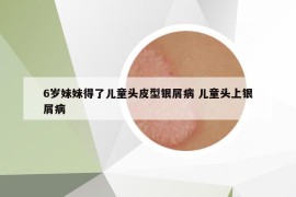 6歲妹妹得了兒童頭皮型銀屑病 兒童頭上銀屑病