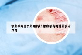銀血病用什么外用藥好 銀血病有哪種藥膏治療有